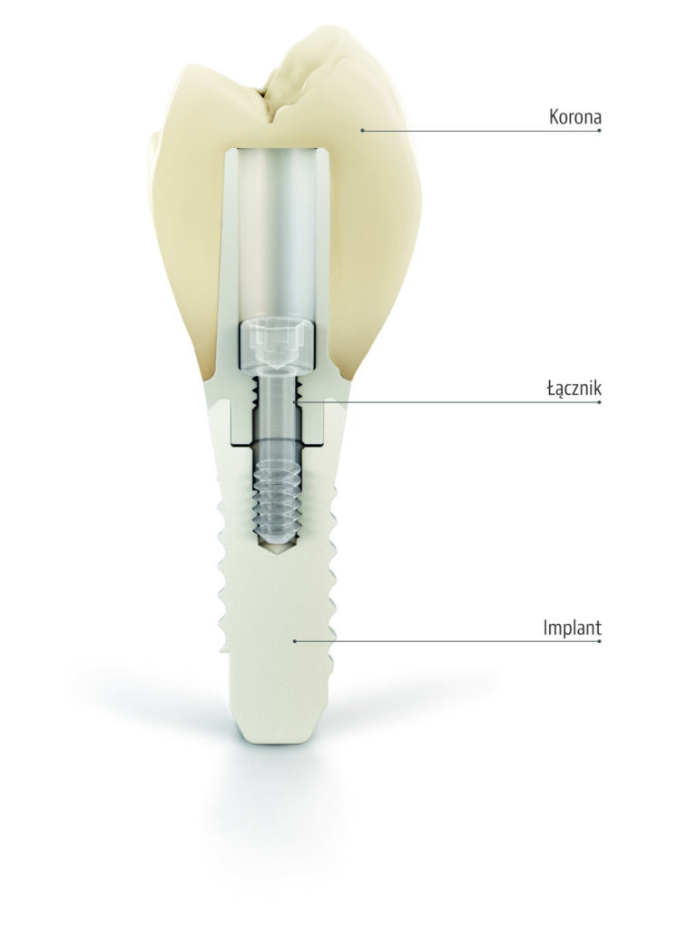 Implanty zębowe Dentiq
