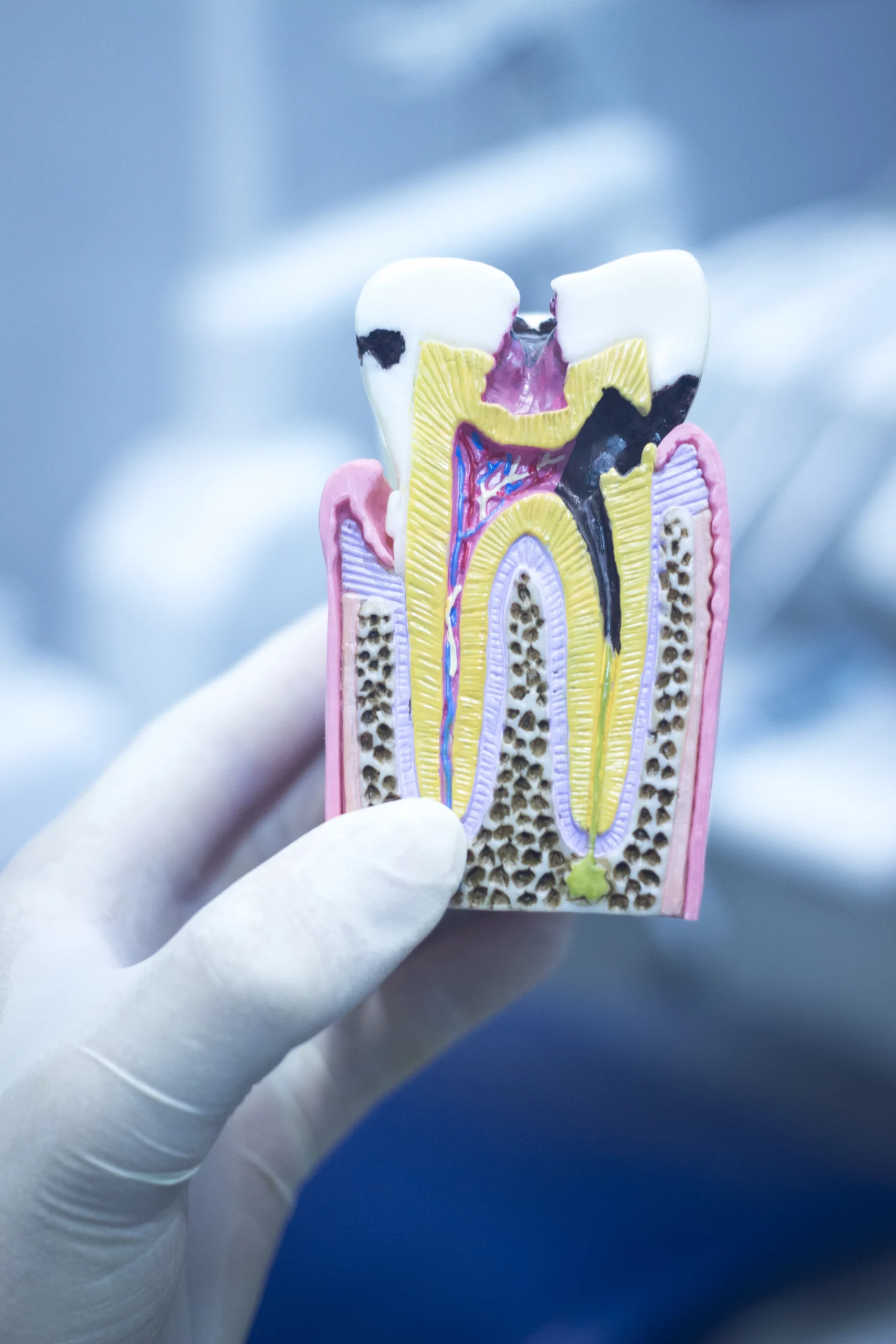 martwy ząb blog dentiq kraków