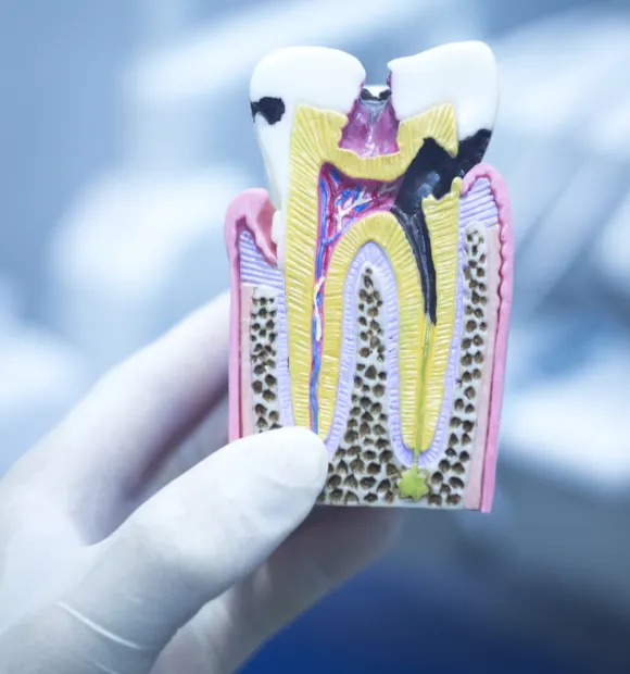 martwy ząb blog dentiq kraków